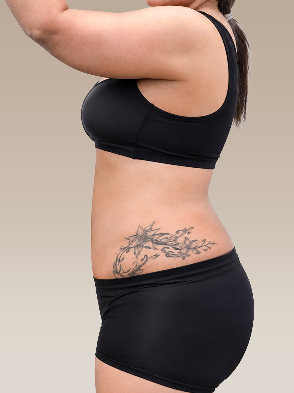 Home 2 - Before After_Body Contouring_After