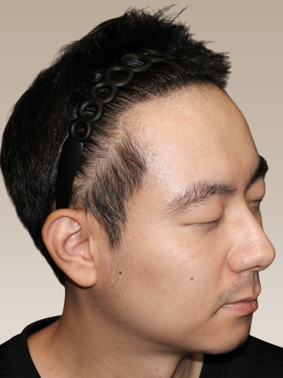 Home 2 - Before After_Male Hair Transplant_After