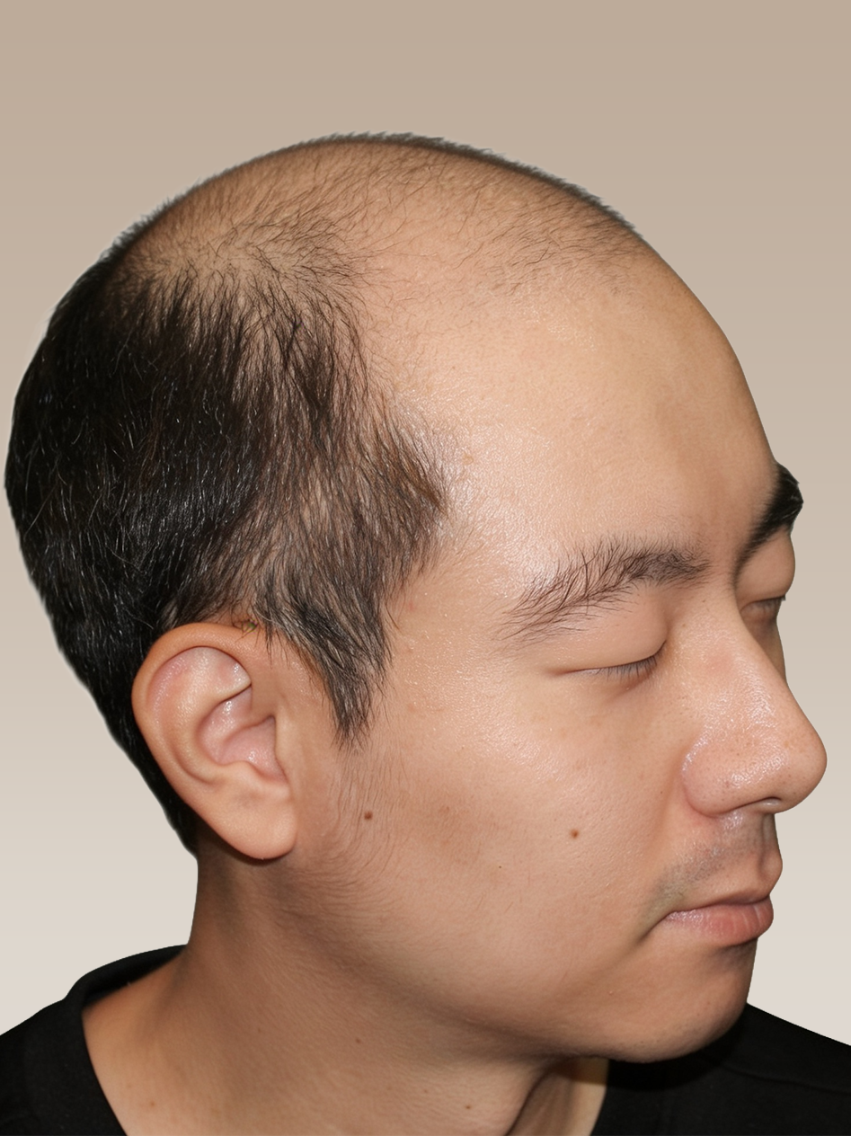 Home 2 - Before After_Male Hair Transplant_Before